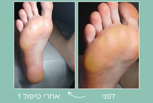 תמונת לפני ואחרי טיפול ביבלות בכף הרגל