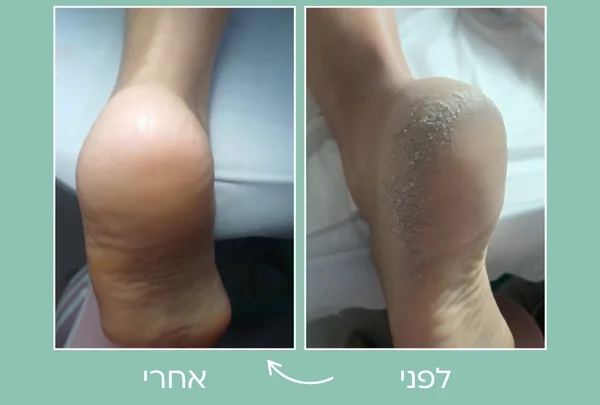 תמונת לפני ואחרי טיפול בעור סדוק בעקב
